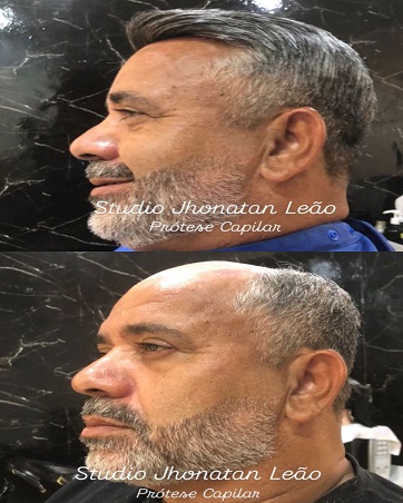 Resultado de prótese capilar