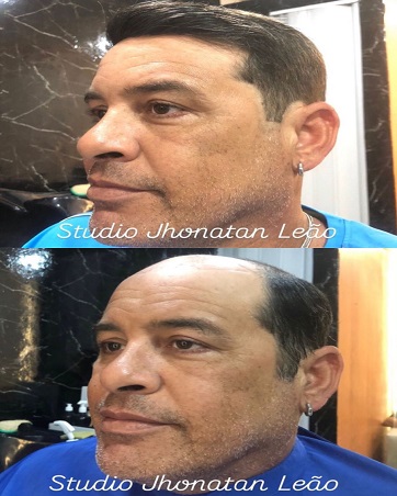 Resultado de prótese capilar