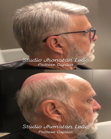 Resultado de prótese capilar