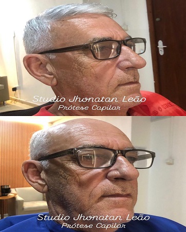 Resultado de prótese capilar